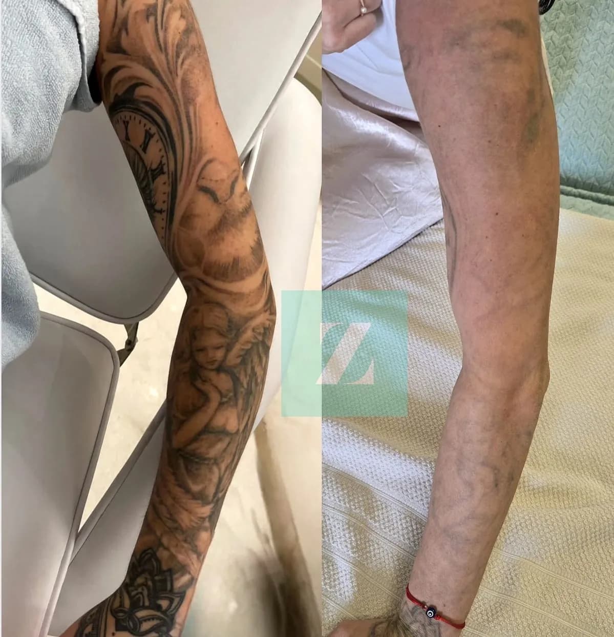 Clean Skin After Tattoo Removal