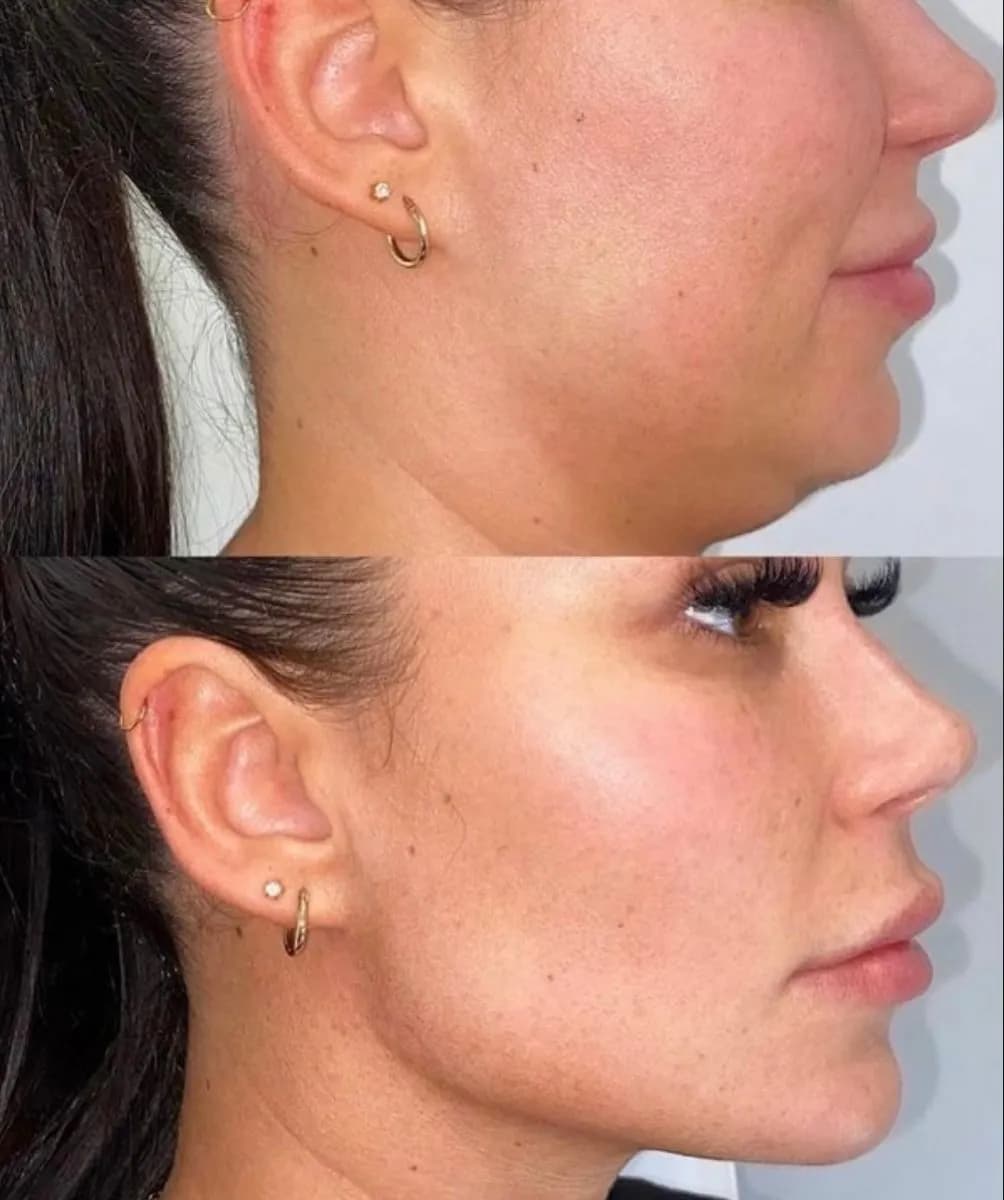 Defined Jawline After Contouring