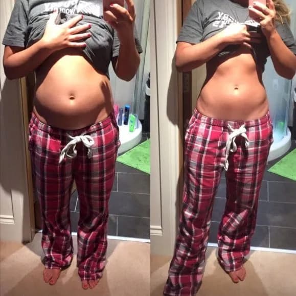 Flat Stomach After Fat Freezing