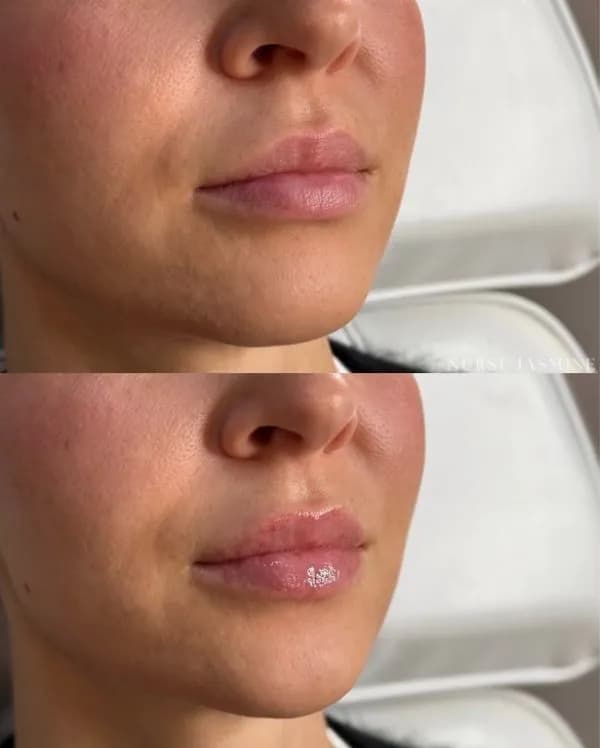 Fuller Lips - Side View