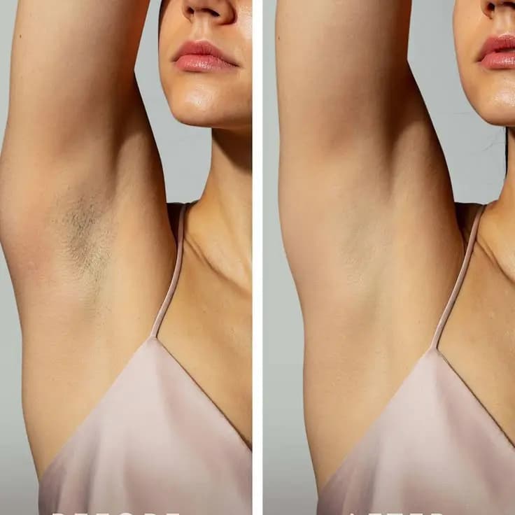 Smooth Underarms After Laser Hair Removal